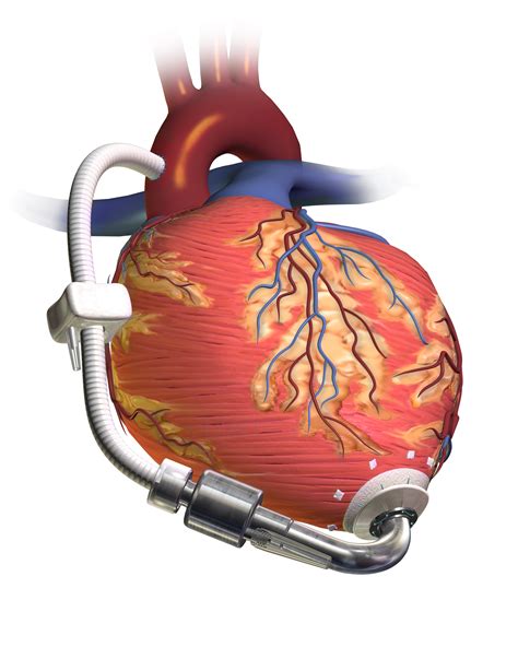 lv machine|artificial heart machine.